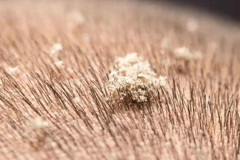 Got Shaved Head Dandruff? Get Rid Of Your Bald Flakes - beardition.com