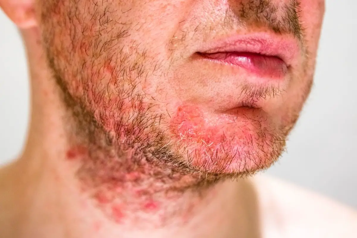 10 Reasons Why The Skin Under Your Beard Hurts